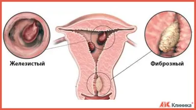 Полип в матке - симптомы, признаки, диагностика и лечение полипов в матке  «Клинике ABC»