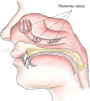 Полипозный риносинусит (полипы полости носа)