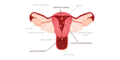 Почему в матке появляются полипы и нужно ли их удалять - Лайфхакер
