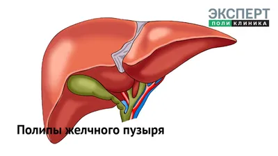 Полипы в желчном пузыре