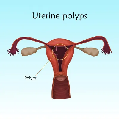 Преимущества лечения полипов матки в клиниках Бельгии