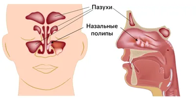 Что такое полипы в носу и как их лечат - Лайфхакер