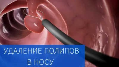 Эндоскопическое удаление полипов в Ташкенте - Круглосуточный Лор центр  клиника в Ташкенте Юнусабаде Чиланзар Лор 24/7 клиника