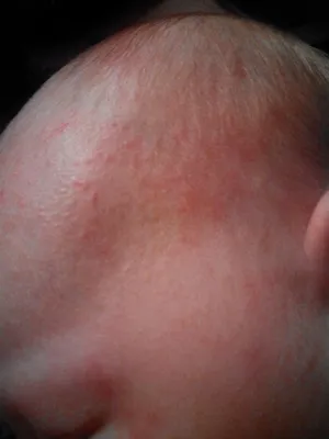 Аллергия или потница у новорожденного - Вопрос дерматологу - 03 Онлайн