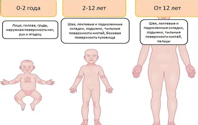 Як відрізнити пітницю від алергії у немовляти або новонародженого (28 фото):  відмінності пітниці і діатезу на обличчі, різниця і особливості