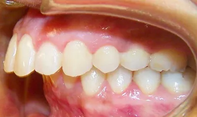 Правильный прикус у человека: фото зубов |