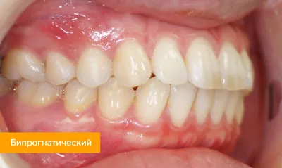 Прикус зубов человека, правильный прикус – виды и аномалии