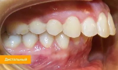 Прикус зубов человека, правильный прикус – виды и аномалии