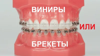 Исправляют ли неправильный прикус с помощью виниров? Мнение ортодонтов и  ортопедов.