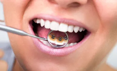 Правильный прикус у человека: фото зубов