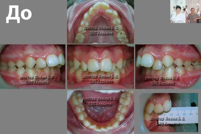 О стоматологии и не только...: Прогнатия (дистальный прикус). Лечение  брекетами