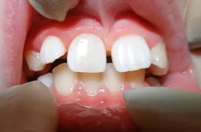 Зубы у детей: порядок прорезывания молочных и коренных элементов, схема,  как они прорезываются у ребенка, сроки, возраст и симптомы для грудничков и  малышей до года