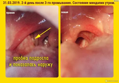 Санация (промывание) гланд (миндалин) в стационаре - «Промывание лакун  миндалин шприцем в Клинической больнице имени С.Р. Миротворцева (3-я гор.  больница, г. Саратов)» | отзывы