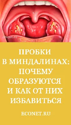 Пробки в миндалинах: Почему образуются и как от них избавиться | Здоровье |  Селдон Новости