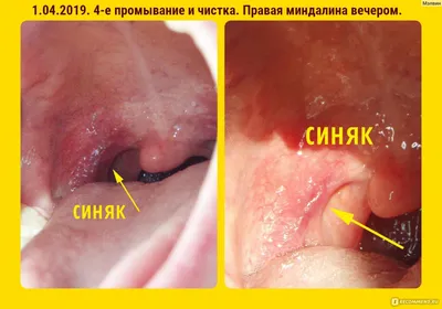 Санация (промывание) гланд (миндалин) в стационаре - «Промывание лакун  миндалин шприцем в Клинической больнице имени С.Р. Миротворцева (3-я гор.  больница, г. Саратов)» | отзывы