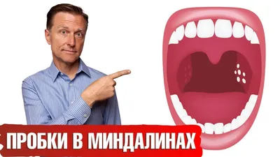 Гнойные пробки в миндалинах👉как предотвратить их появление - YouTube