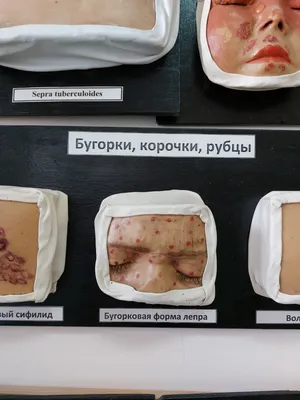 В России ликвидируют единственный в стране институт по изучению лепры |  ForPost