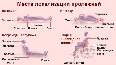 Профилактика пролежней у лежачих больных - АНО СОН \