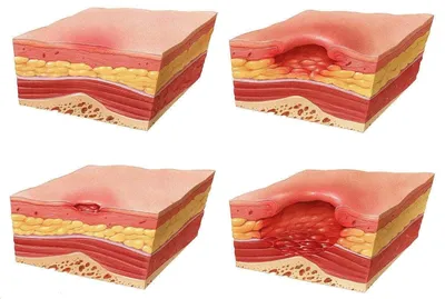 Профилактика пролежней у лежачих больных. Услуги лечения пролежней в  пансионатах Подмосковья