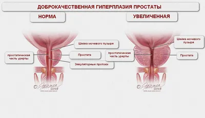 Аденома предстательной железы | Симптомы, осложнения, диагностика и лечение  | ВЦЭРМ им. А.М. Никифорова МЧС России в Санкт-Петербурге