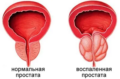 Простатит: острый и хронический; симптомы и лечение