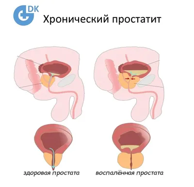 Простатит и кровь в сперме как связаны