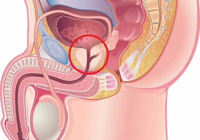 Бактериальный простатит: причины, симптомы и последствия