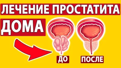 Как вылечить простатит