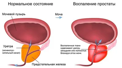 Хронический простатит: причины, симптомы, народные средства для лечения и  медицинский взгляд - АЛМ Медицина