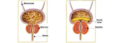 Простатит: диагностика, лечение и профилактика. | Москва