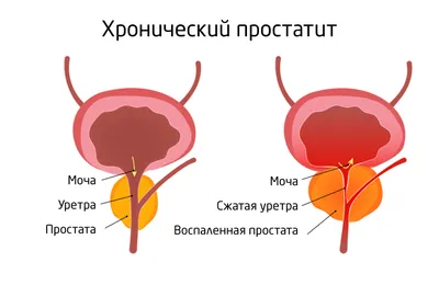 Хронический простатит | Симптомы, причины, лечение у мужчин ᐉ Гармония  здоровья