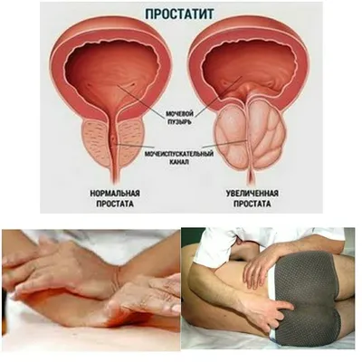 ОСТЕОПАТИЧЕСКОЕ ЛЕЧЕНИЕ ПРОСТАТИТА » Евразийский Институт Остеопатической  Медицины