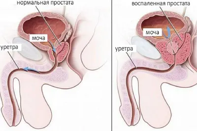 Эффективное лечение простатита у мужчин в Санкт-Петербурге | Медицинская  клиника GMC