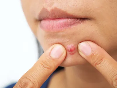 Стероидные угри: как вылечить угревую сыпь на спине и лице