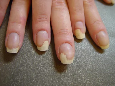 Псориаз ногтей: причины, симптомы, лечение. Причины возникновения и лечение  псориаза ногтей. Причины возникновения псориаза ногтей. Как проявляется псориаз  ногтей и как его вылечить.BagiraClub Женский клуб