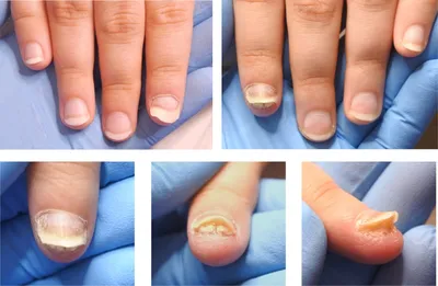 Торпидное течение псориаза ногтей у детей ✓ Авторские статьи Клиники  Подологии