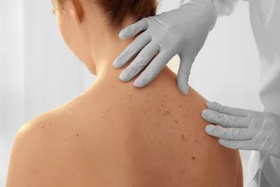 Псориаз на коже: причины, симптомы и варианты лечения неприятной болезни |  WMJ.ru