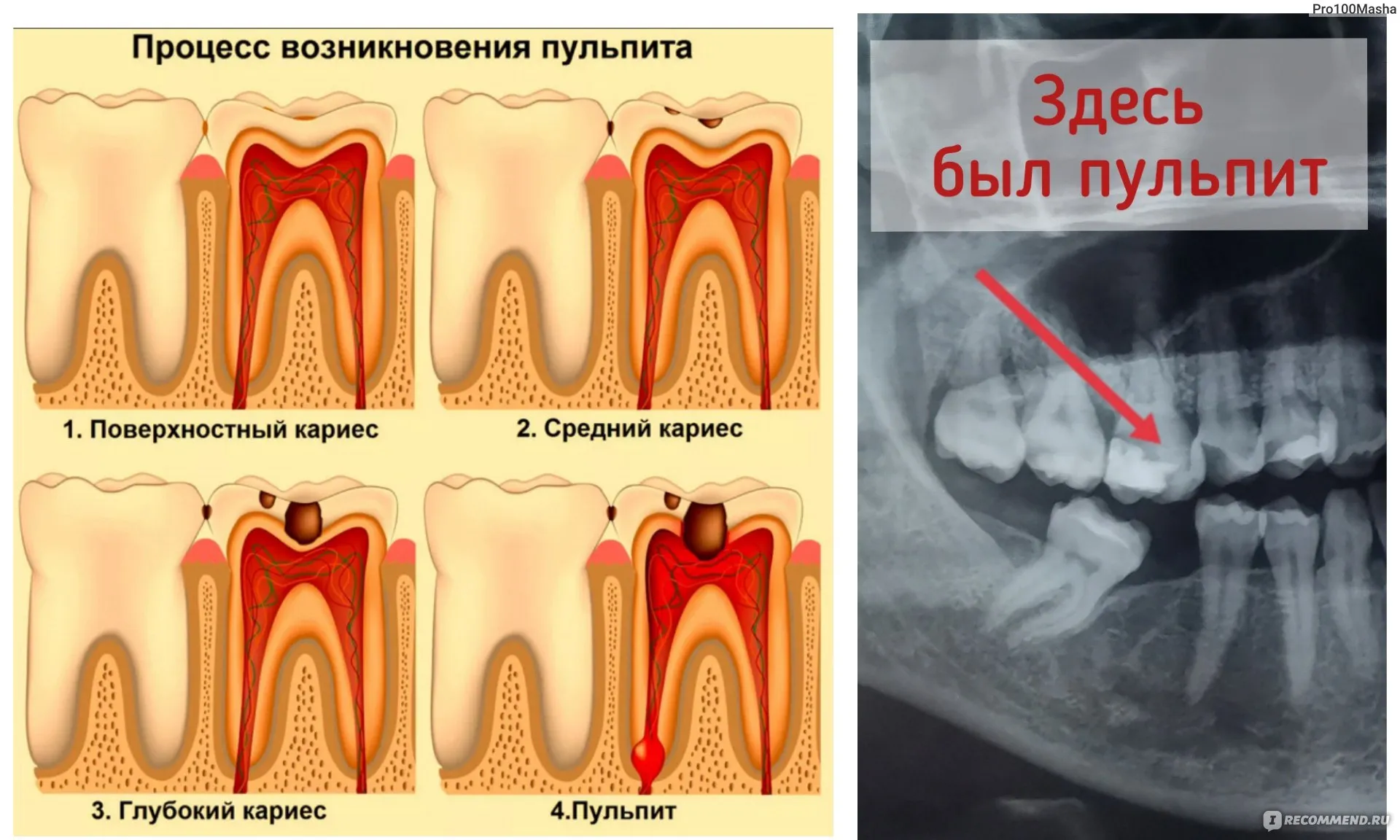 Депульпация зуба