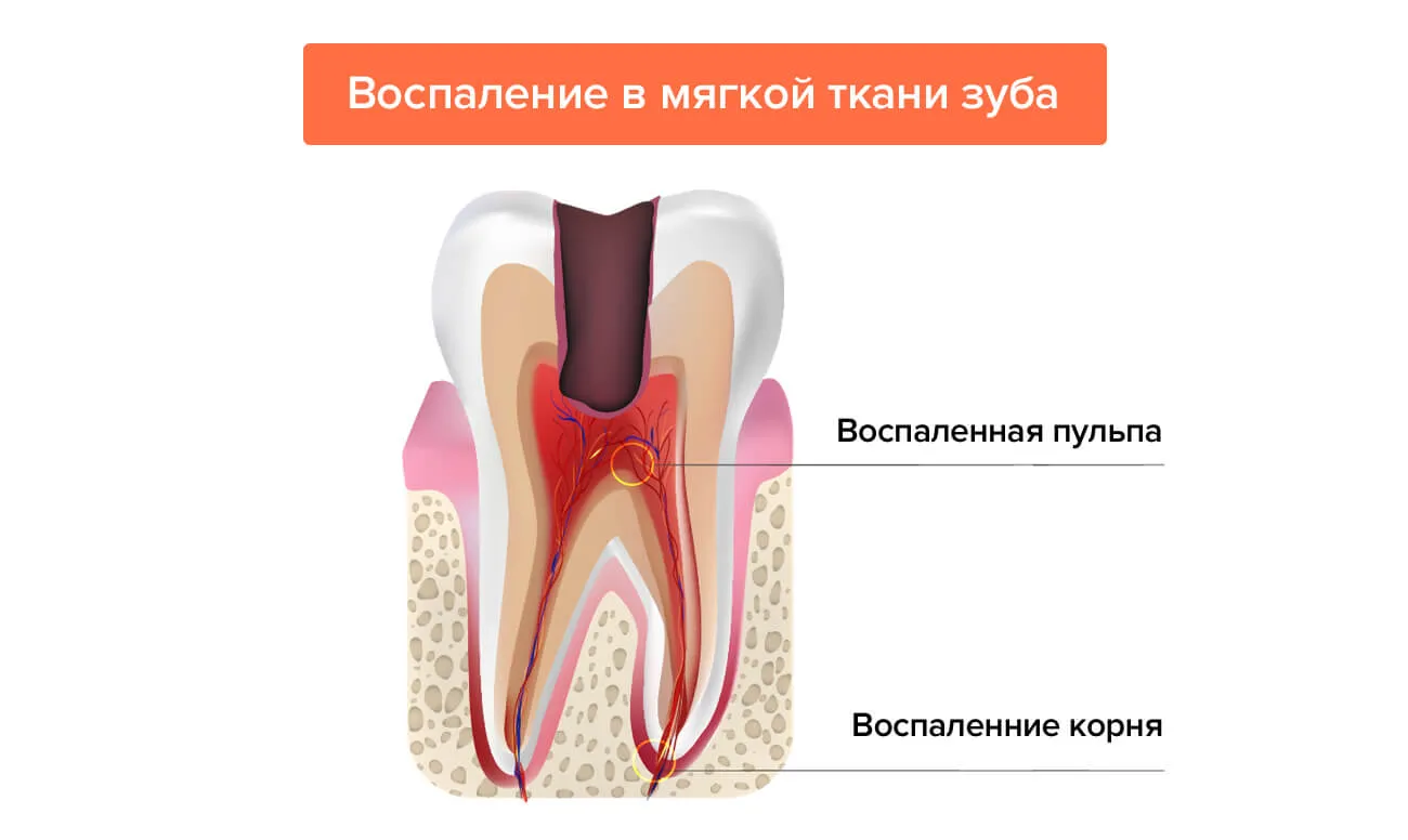 Периодонтит и пульпит разница. Воспаление зуба пульпит.