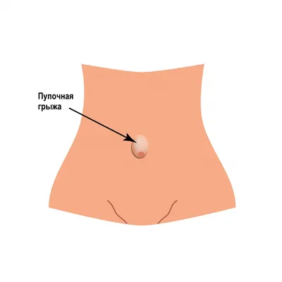 Пупочная грыжа - причины появления, симптомы заболевания, диагностика и  способы лечения