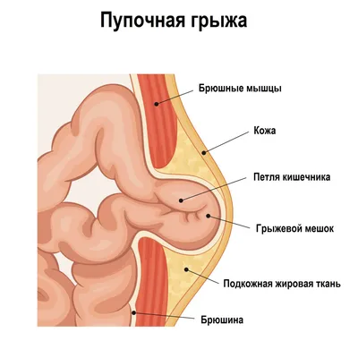 Грыжи - причины появления, симптомы заболевания, диагностика и способы  лечения