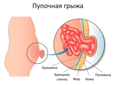 Операция по удалению пупочной грыжи (герниопластика) у мужчин и женщин:  питание после лечения, как делают операцию, реабилитация