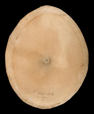Пустула оспы на восьмой день болезни. Акварель У. Каффа, 1800.