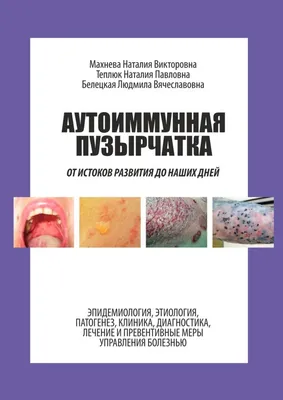 Аутоиммунная пузырчатка. От истоков развития до наших дней, Наталия  Викторовна Махнева – скачать книгу fb2, epub, pdf на Литрес