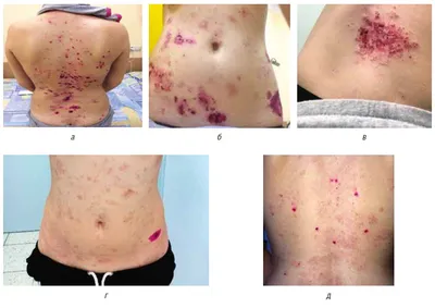 IgG/IgA-pemphigus — extremely rare blistering autoimmune diseases -  Karamova - Vestnik dermatologii i venerologii