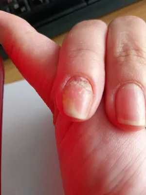 Водянистые пузырьки вокруг ногтя - Вопрос дерматологу - 03 Онлайн