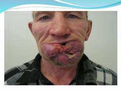 Рак губы. Заболеваемость - презентация онлайн