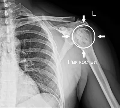 Рак костей: первые симптомы, фото, лечение, стадии и прогноз жизни