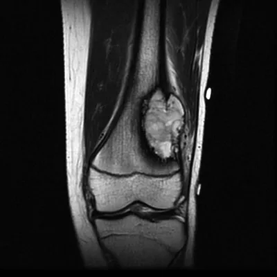 МРТ рака костей скелета - протокол диагностики, признаки на МРТ снимках