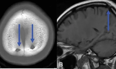 Опухоли костей черепа: симптомы, диагностика, лечение в Херсоне |  Neuro.ks.ua.